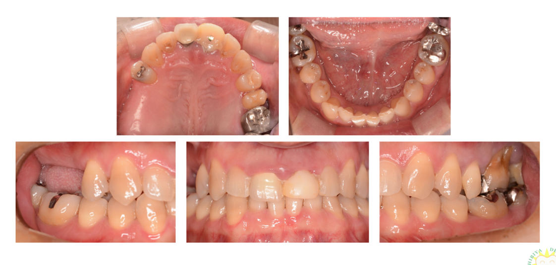 インプラント治療例