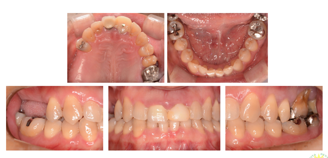 インプラント治療例