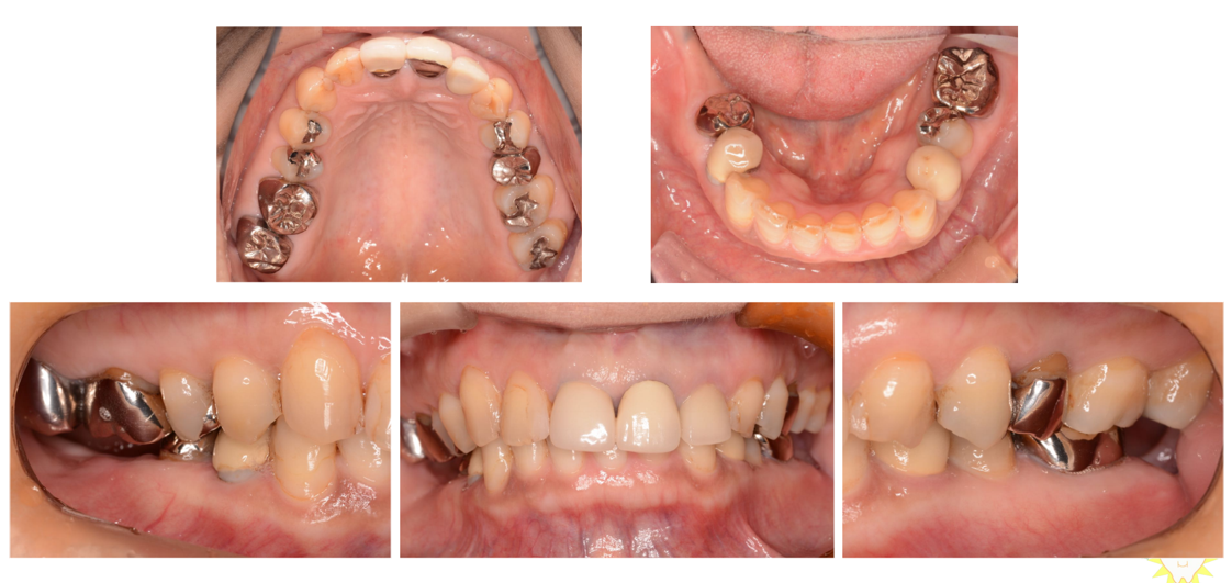 インプラント治療例