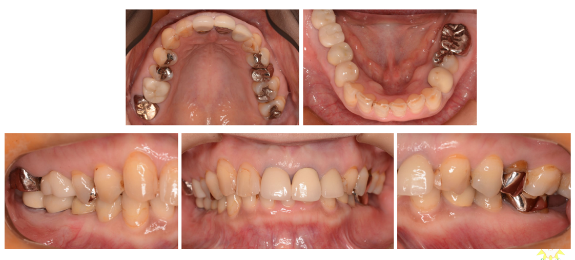 インプラント治療例