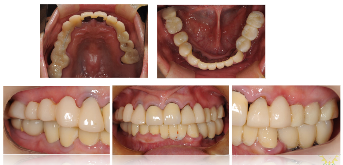 インプラント治療例