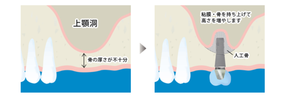 サイナスリフト
