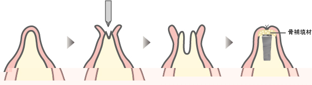 スプリットクレスト